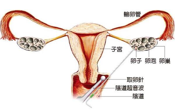 杭州试管婴儿