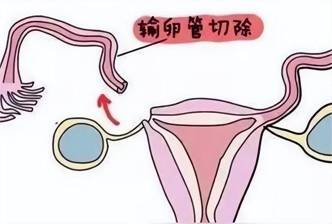 试管婴儿费用
