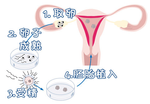 兰州捐卵