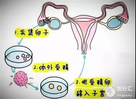 内江供卵代怀